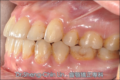 前牙錯咬為何要治療和如何改善 前牙錯咬為何要治療和如何改善