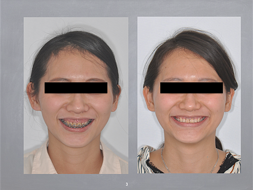 揚起下顎 翻轉人生