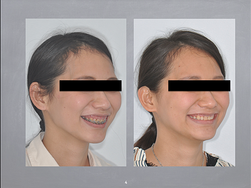 揚起下顎 翻轉人生