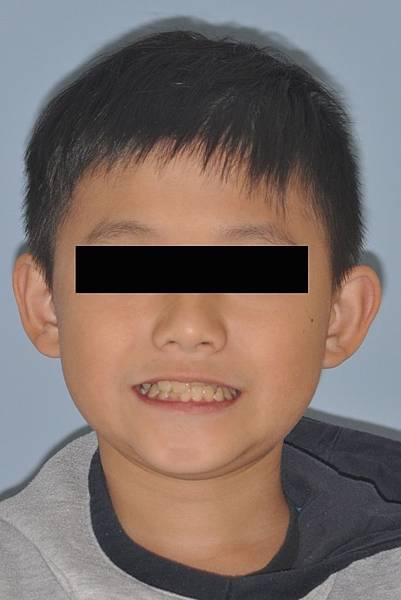 混合齒列前牙錯咬改善