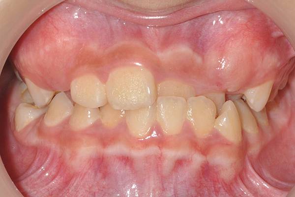 混合齒列前牙錯咬改善