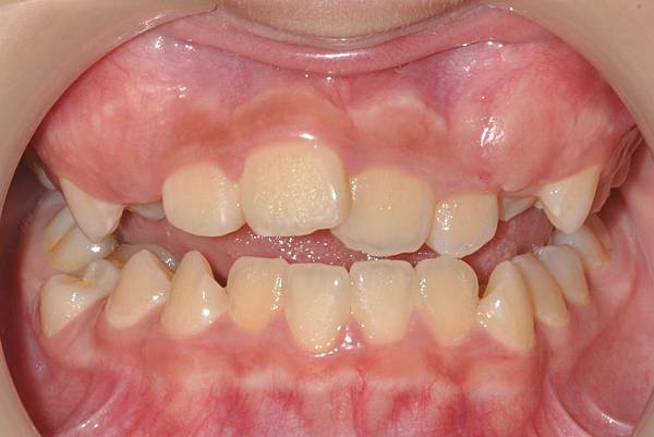 混合齒列前牙錯咬改善