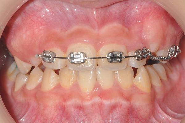 混合齒列前牙錯咬改善