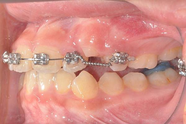 混合齒列前牙錯咬改善