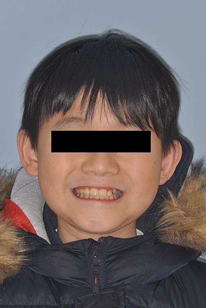 混合齒列前牙錯咬改善