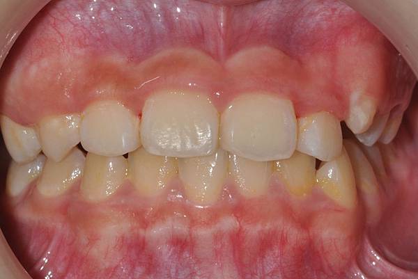 混合齒列前牙錯咬改善