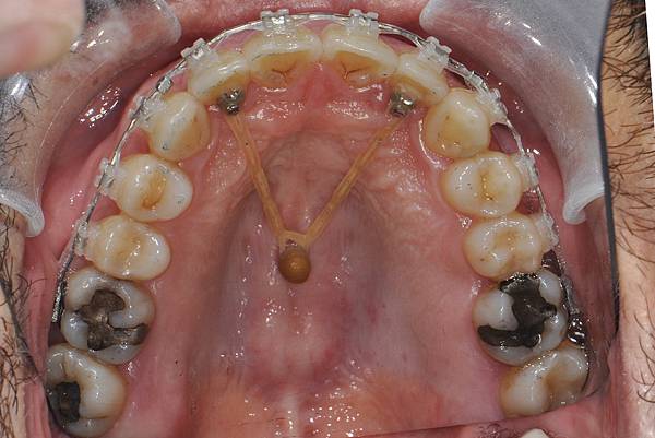 上顎全齒列後移 改善深咬/暴牙/二級咬合 (HPPG technique)