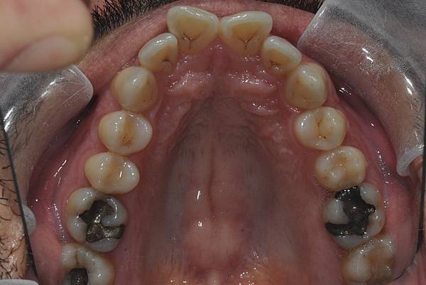 上顎全齒列後移 改善深咬/暴牙/二級咬合 (HPPG technique)