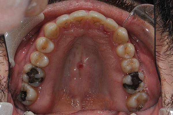 上顎全齒列後移 改善深咬/暴牙/二級咬合 (HPPG technique)