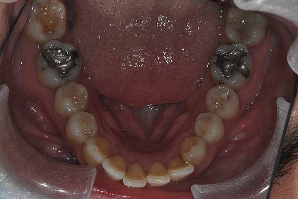 上顎全齒列後移 改善深咬/暴牙/二級咬合 (HPPG technique)