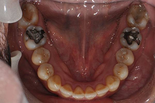 上顎全齒列後移 改善深咬/暴牙/二級咬合 (HPPG technique)