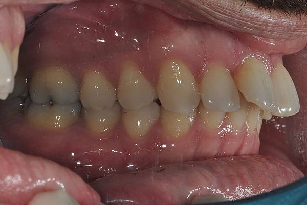 上顎全齒列後移 改善深咬/暴牙/二級咬合 (HPPG technique)