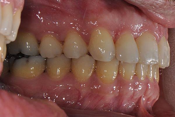 上顎全齒列後移 改善深咬/暴牙/二級咬合 (HPPG technique)