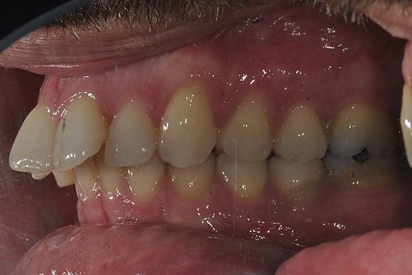 上顎全齒列後移 改善深咬/暴牙/二級咬合 (HPPG technique)