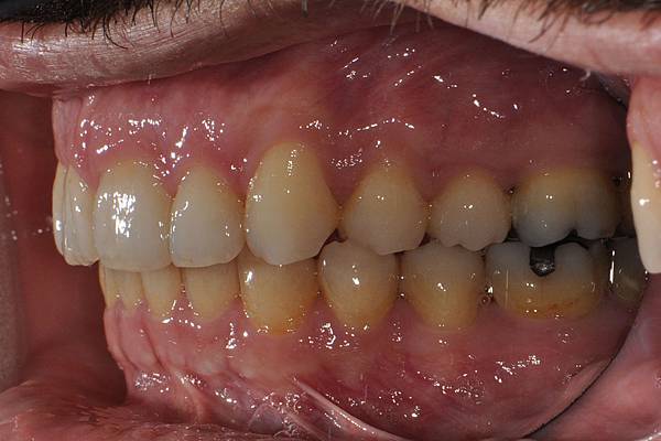 上顎全齒列後移 改善深咬/暴牙/二級咬合 (HPPG technique)