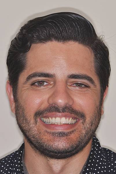 上顎全齒列後移 改善深咬/暴牙/二級咬合 (HPPG technique)