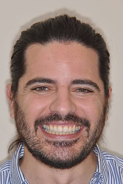 上顎全齒列後移 改善深咬/暴牙/二級咬合 (HPPG technique)