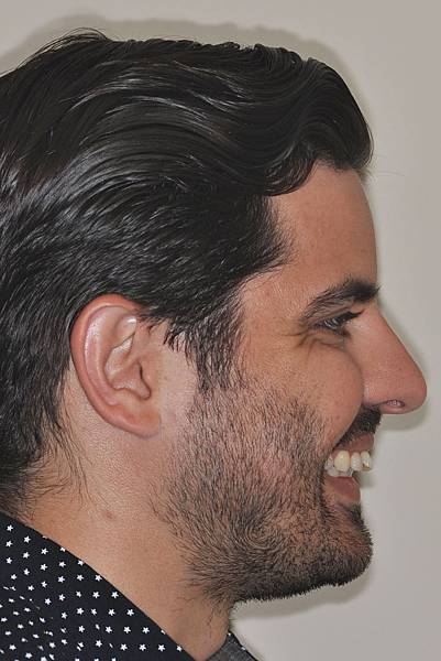 上顎全齒列後移 改善深咬/暴牙/二級咬合 (HPPG technique)