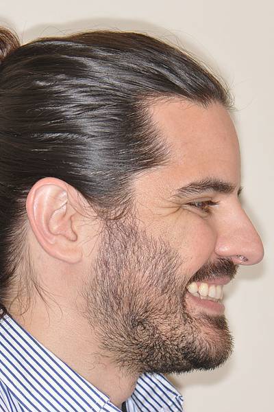 上顎全齒列後移 改善深咬/暴牙/二級咬合 (HPPG technique)