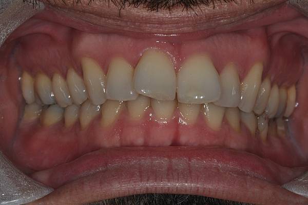 上顎全齒列後移 改善深咬/暴牙/二級咬合 (HPPG technique)