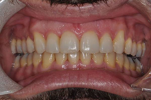 上顎全齒列後移 改善深咬/暴牙/二級咬合 (HPPG technique)