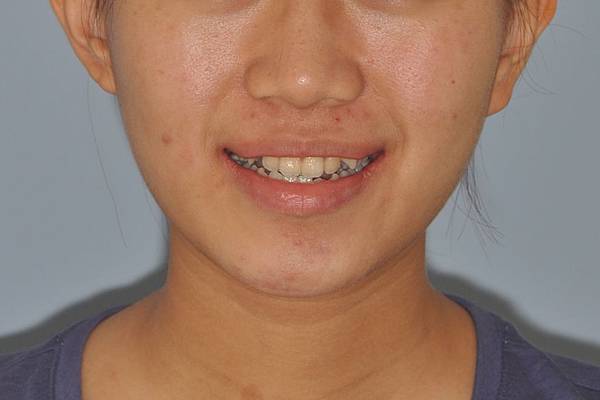 戽斗下唇突出改善案例