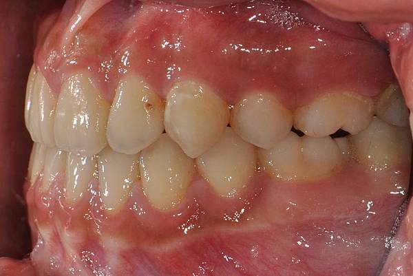 戽斗下唇突出改善案例