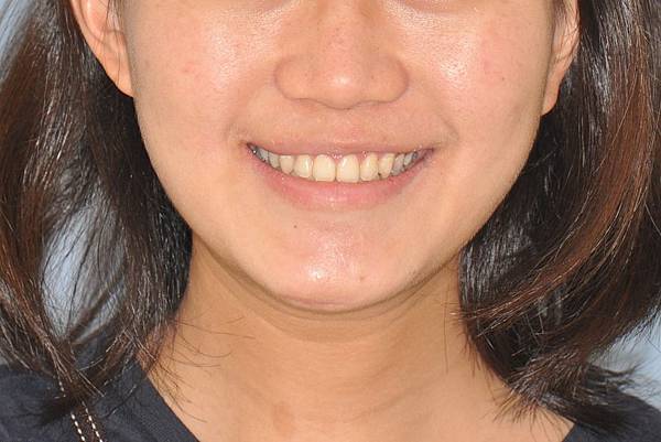 戽斗下唇突出改善案例