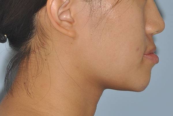 戽斗下唇突出改善案例