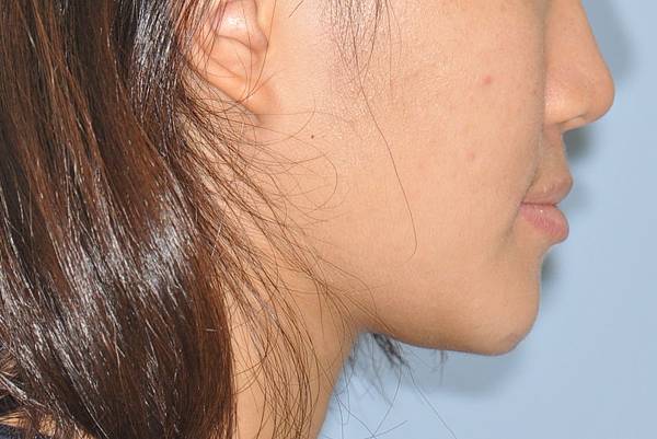 戽斗下唇突出改善案例