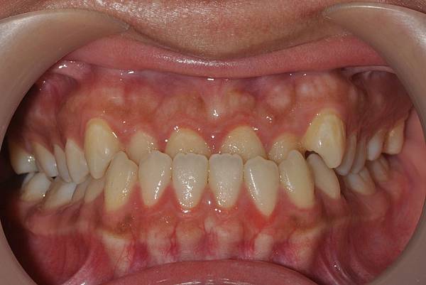 戽斗下唇突出改善案例