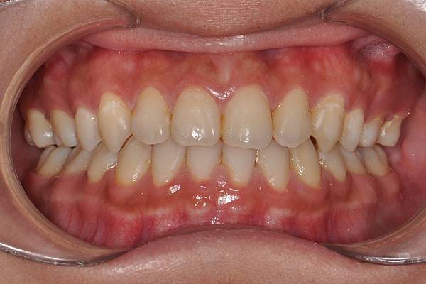 戽斗下唇突出改善案例