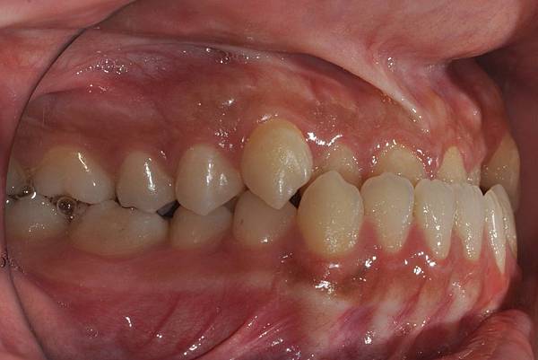 戽斗下唇突出改善案例