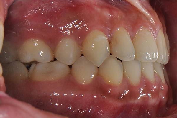 戽斗下唇突出改善案例