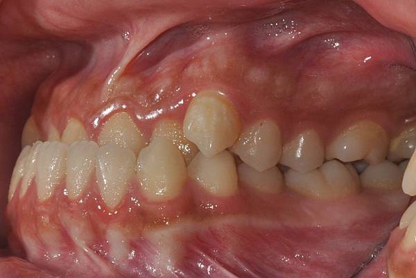 戽斗下唇突出改善案例