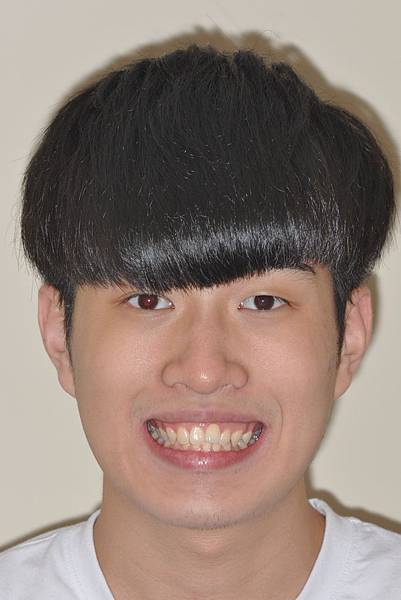 利用牙弓擴張改善微笑弧度