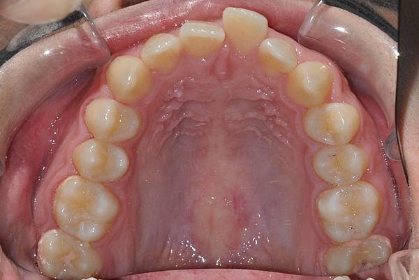 利用牙弓擴張改善微笑弧度