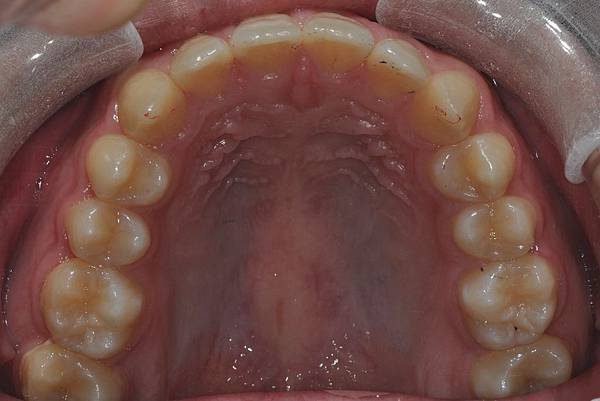 利用牙弓擴張改善微笑弧度