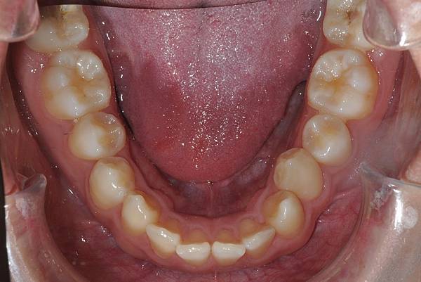 利用牙弓擴張改善微笑弧度