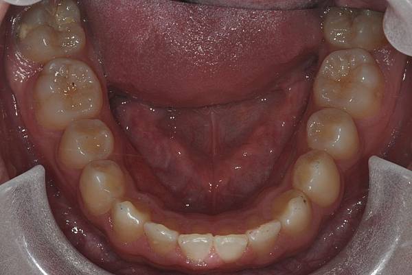 利用牙弓擴張改善微笑弧度