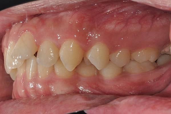 利用牙弓擴張改善微笑弧度