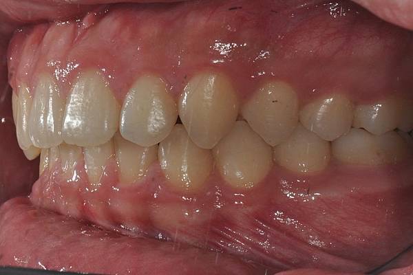 利用牙弓擴張改善微笑弧度