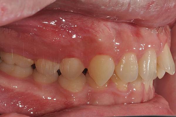 利用牙弓擴張改善微笑弧度