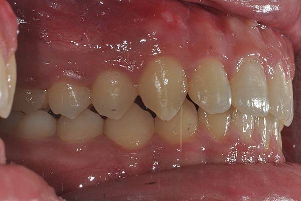 利用牙弓擴張改善微笑弧度