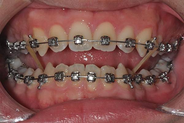 利用牙弓擴張改善微笑弧度