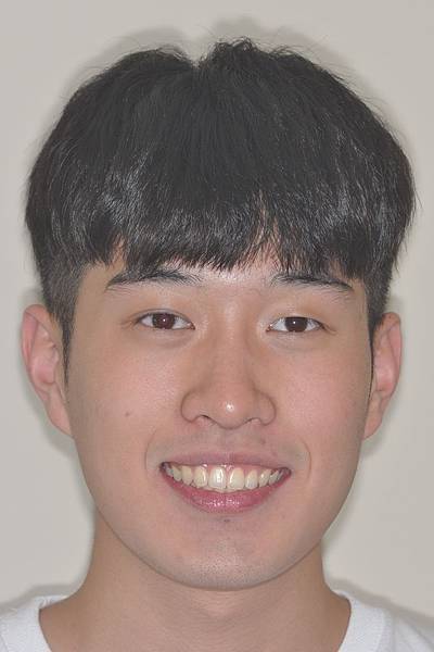 利用牙弓擴張改善微笑弧度