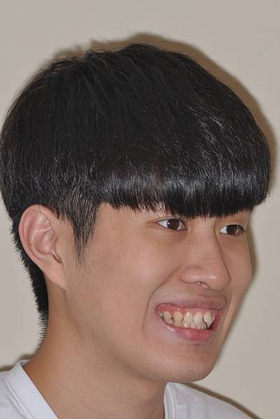 利用牙弓擴張改善微笑弧度