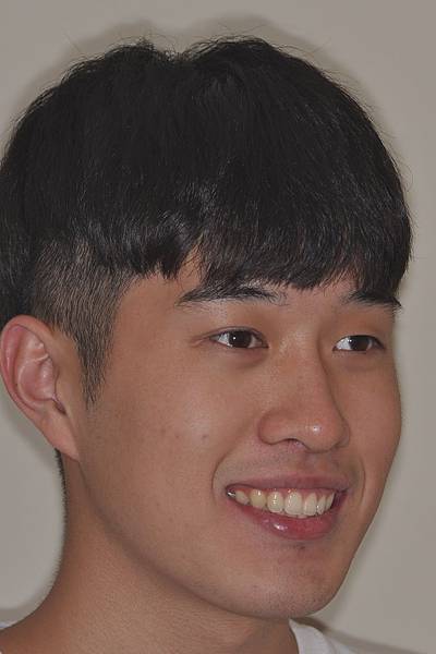 利用牙弓擴張改善微笑弧度