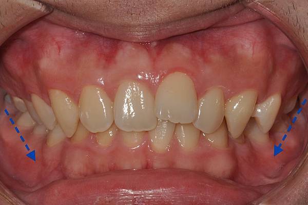 利用牙弓擴張改善微笑弧度