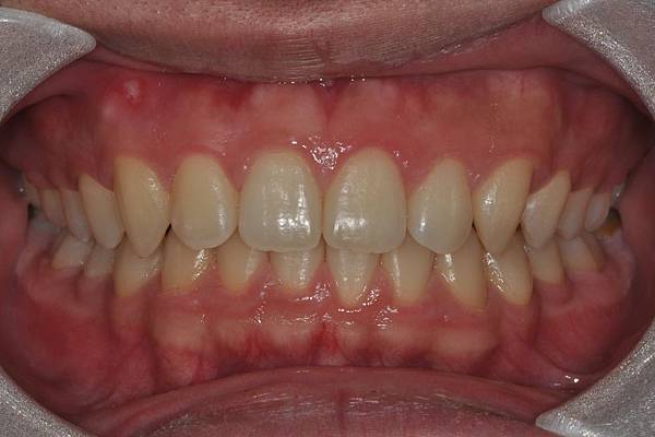 利用牙弓擴張改善微笑弧度